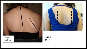 Energy Healing for Misaligned Back